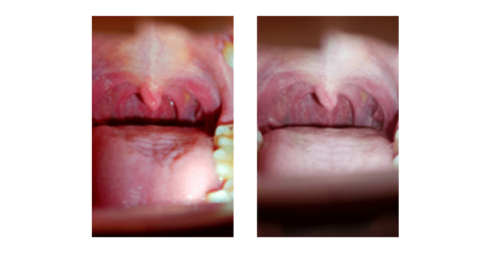 Результаты снижения покраснения в горле после применения Тантум Верде