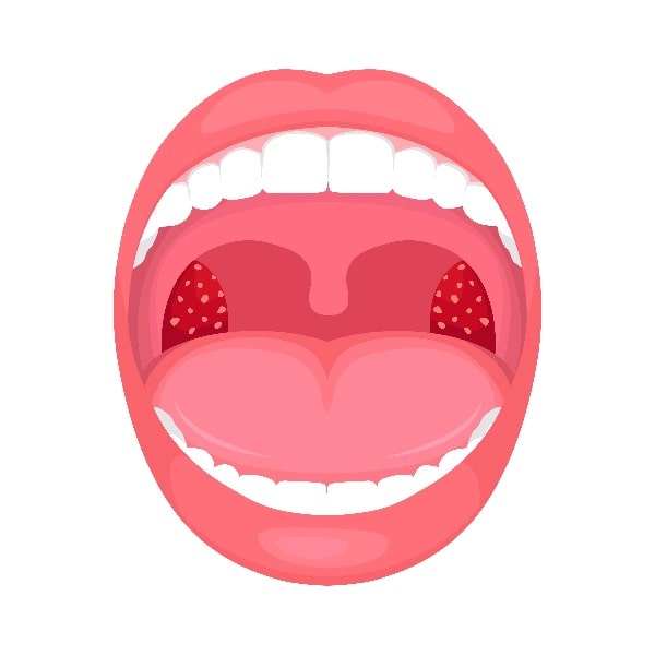 Дрожжевая инфекция горла, или кандидоз полости рта: что нужно знать