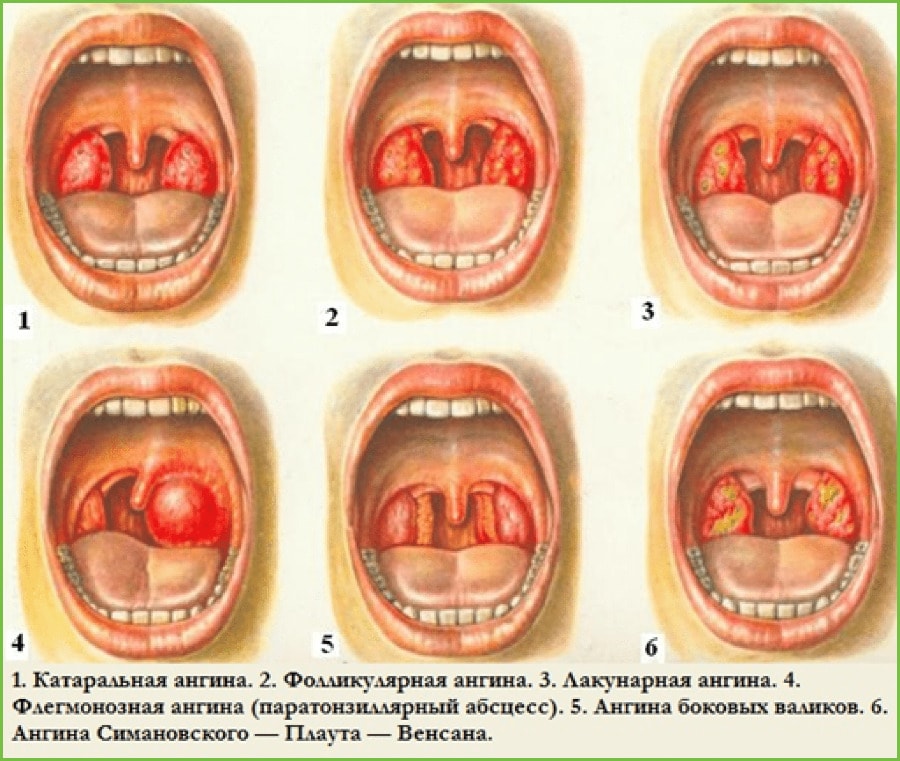 Симптомы заболевания горла ребенка