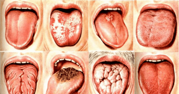 Лечение заболеваний слизистой оболочки полости рта в Салехарде в стоматологии Элит-Дент