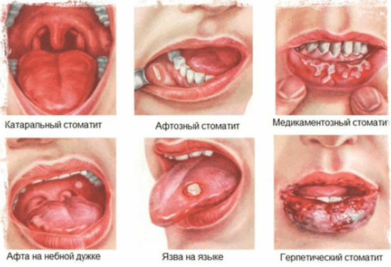 Воспаления слизистой рта и стоматит
