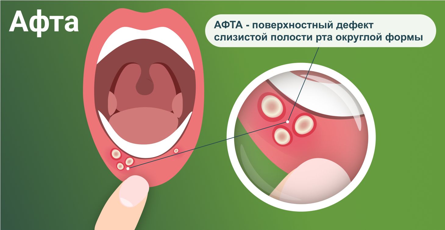 Стоматит: всё о методах лечения и препаратах.