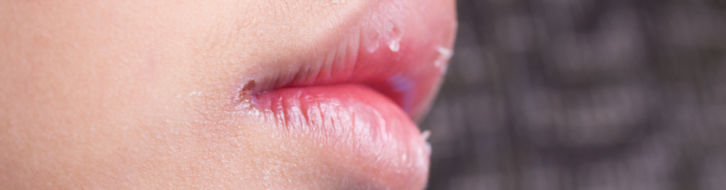 Пузырьки на губах – дело не только в красоте