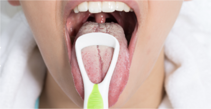 Гигиена полости рта при складчатом глоссите