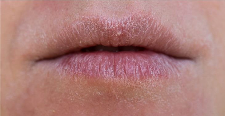 Причины сухости губ и образования корочек
