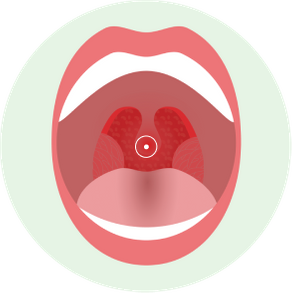 Как выглядит горло у ребенка при ангине (тонзиллите)