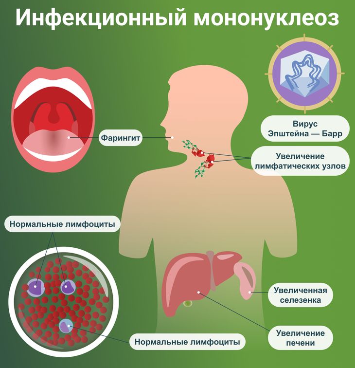Инфекционный мононуклеоз