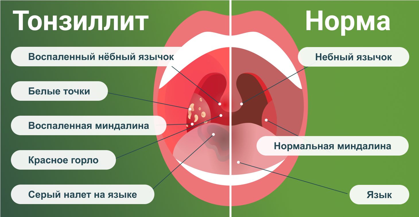 что будет если делать минет при гнойной ангине фото 75