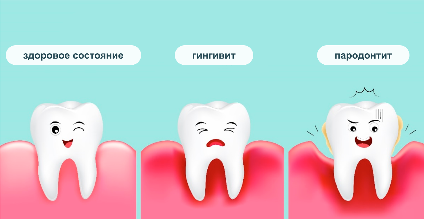 Состояние зубов и десен при гингивите